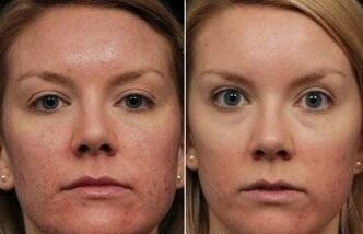 Laser rejuvenation wajah sateuacan sareng saatos