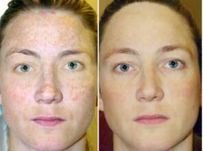 aturan perawatan kulit sanggeus rejuvenation fractional