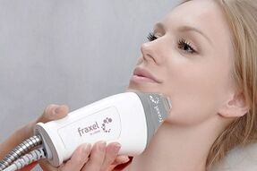 hakekat prosedur rejuvenation kulit raray fractional