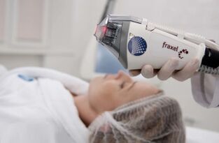 mesin laser rejuvenation fractional