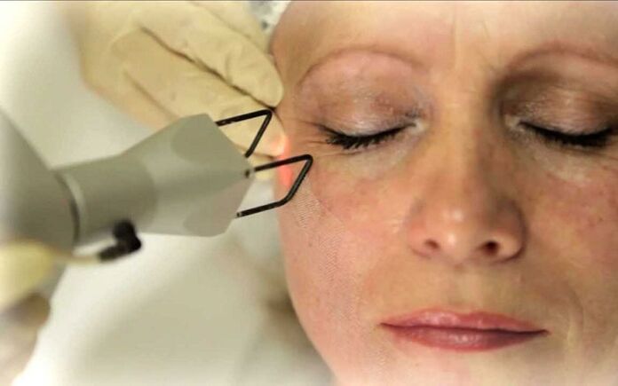 laser ngaleupaskeun wrinkles sabudeureun panon