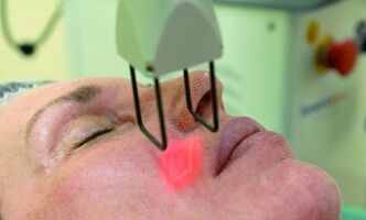 ngalaksanakeun prosedur rejuvenation laser fractional